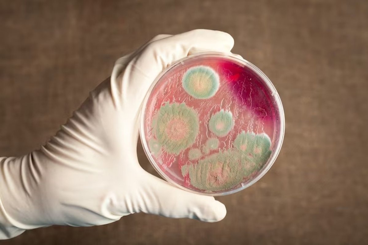 сибирская язва