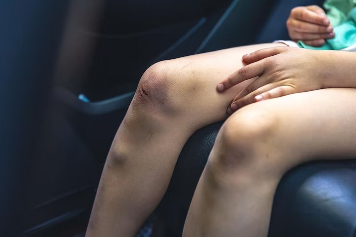 синяк